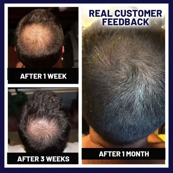 HZA™ Spray natural para el crecimiento del cabello