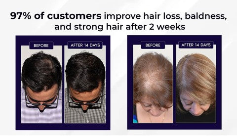HZA™ Spray natural para el crecimiento del cabello