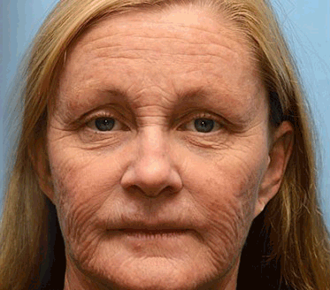 🧑‍⚕️TLOPA® Botox Bee Venom Wrinkle Removal Cream🔥