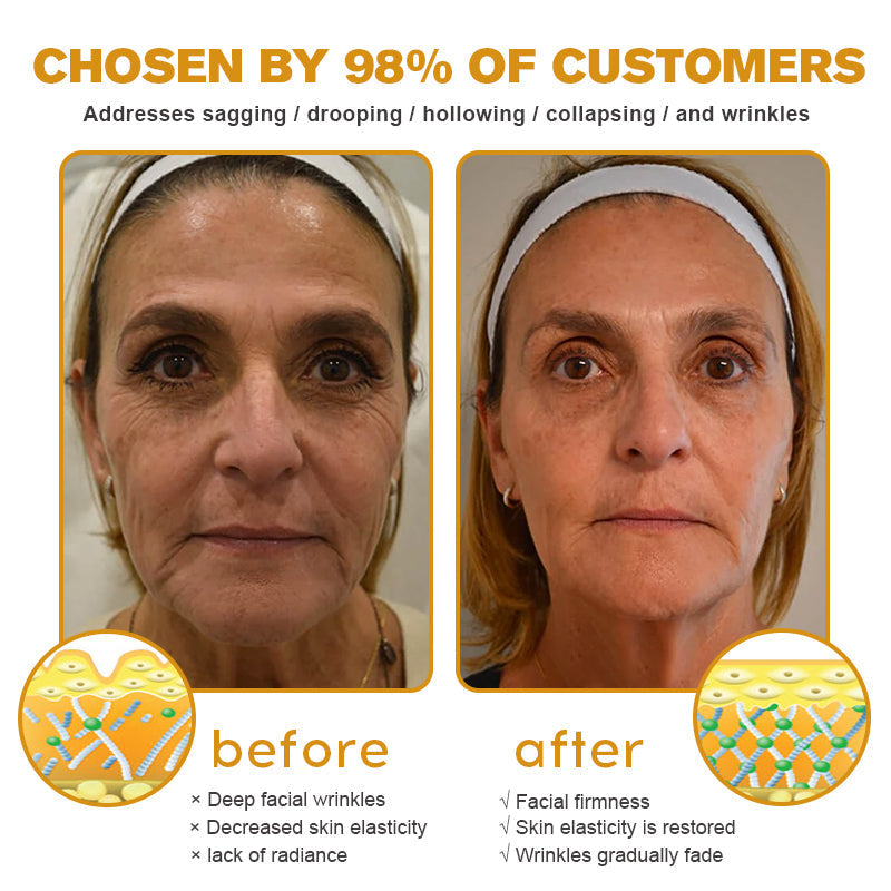 🧑‍⚕️TLOPA® Botox Bee Venom Wrinkle Removal Cream🔥