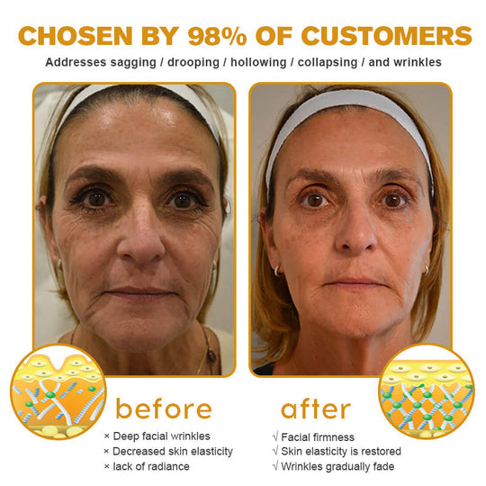 🧑‍⚕️TLOPA® Botox Bee Venom Wrinkle Removal Cream🔥